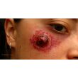 Proteza latex pustula-REPT
